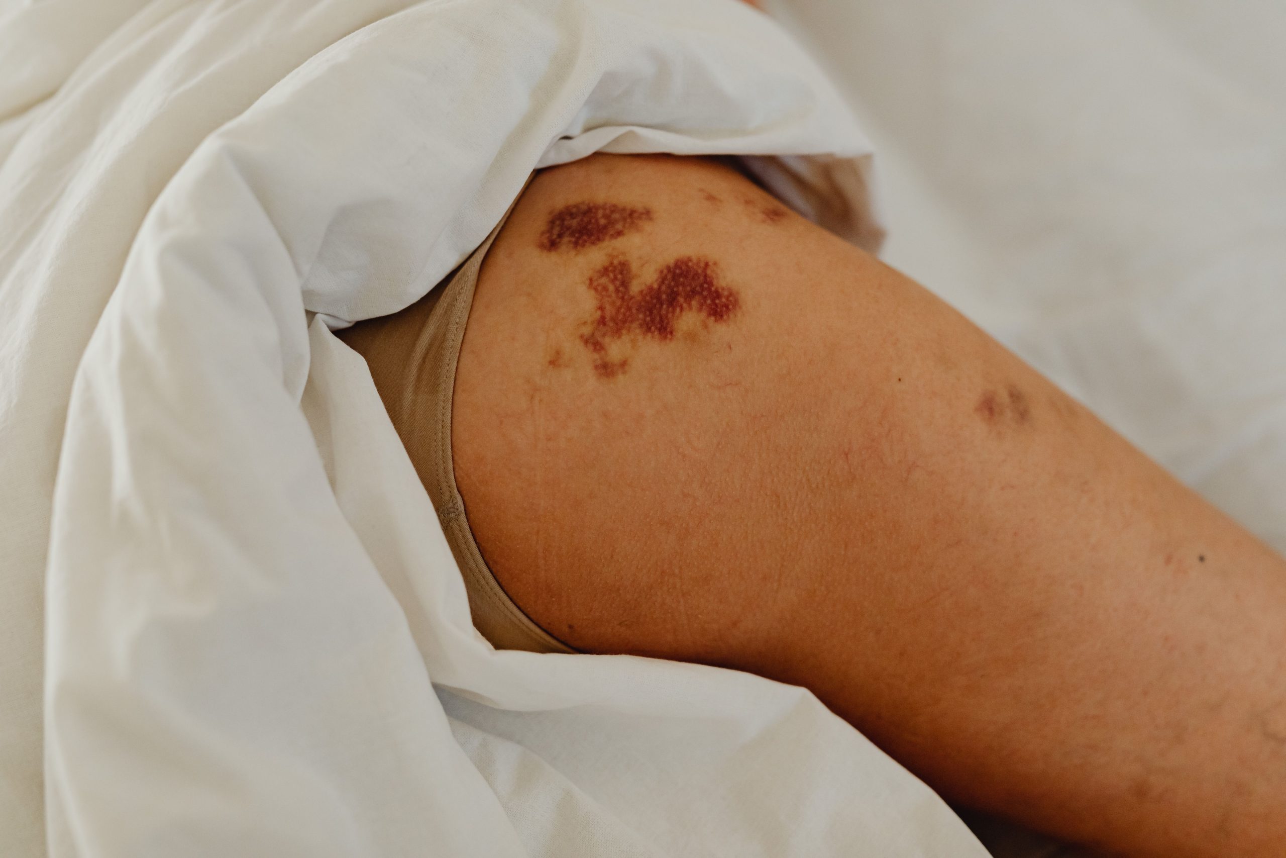Jambe avec marques rouges de piqûres punaises